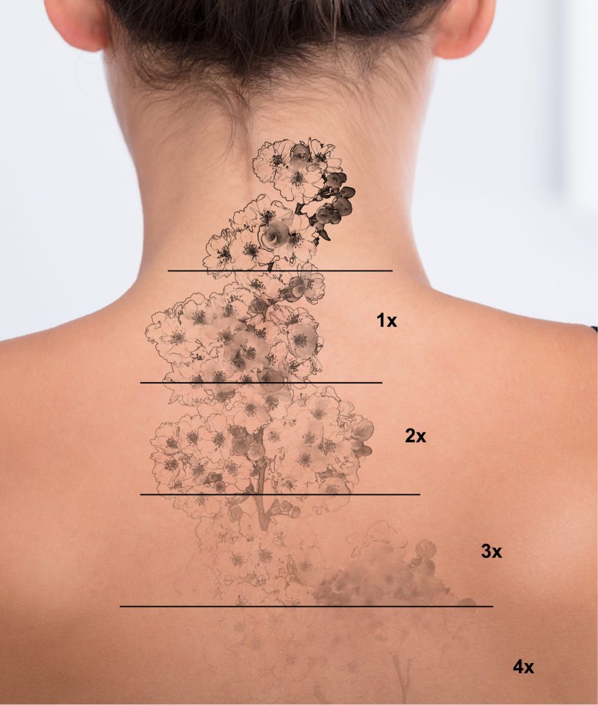 Tattoo removal on a woman's neck